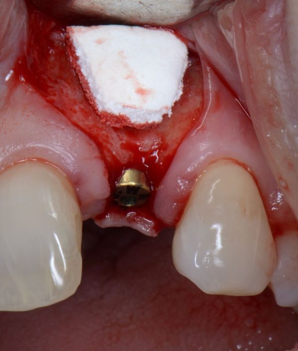 Powerbone Flexible Graft (Full Synthetic)