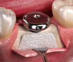 Powerbone Flex tissue suport matrix