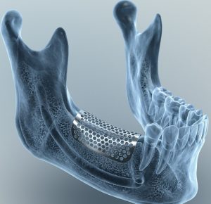 customisble titanium mesh