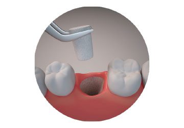 Parasorb cone, Dense collagen Cone, Haemostat, socket preservation
