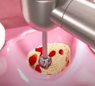 Degranulation burr