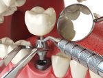Dental Implant Restoration