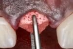 Powerbone SOCKET CONE GRAFT