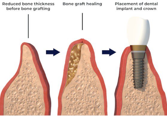 why use a bone graft