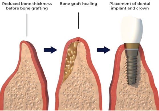 why use a bone graft