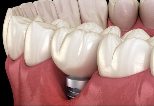 peri-implantitis and NiTi brushes