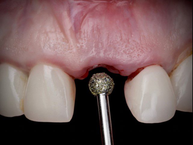 degranulation burrs