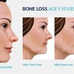 dental bone atrophy