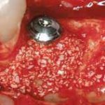 autogenous bone graft