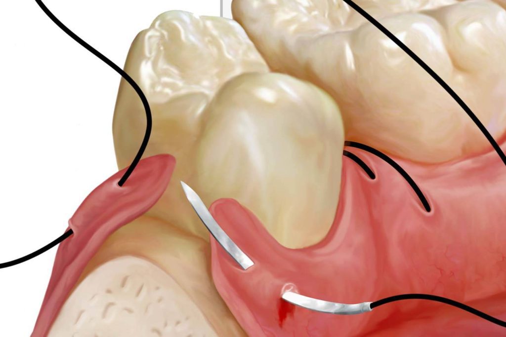 dental sutures at restore surgical